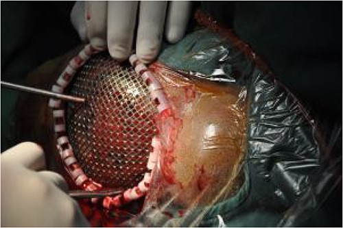 Skull defect repair using titanium mesh.
