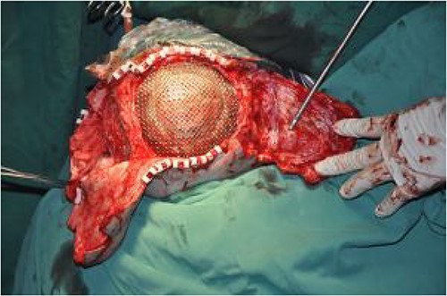 Transfer of two dilated skin flaps to repair the scalp defect.