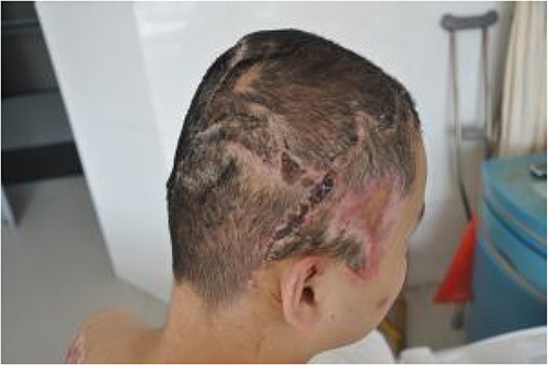 Good survival of the two skin flaps 1 month after discharge.