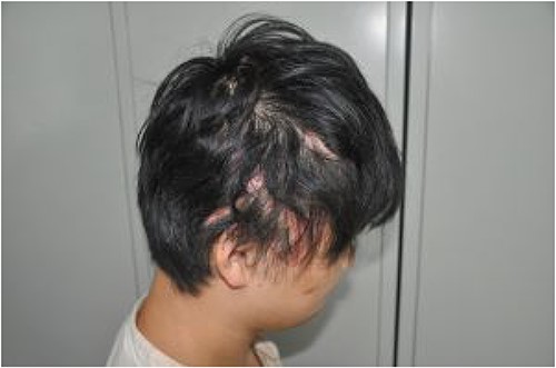 Normal hair growth without alopecia at 6 months after discharge.