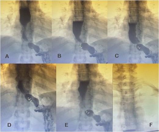 Esophagogastroduodenal transit with barium contrast. (A) Enlarged esophagus; (B) area of stenosis; (C-E) fundoplication and hiatal hernia with stomach above the diaphragmatic domes; tertiary F waves.