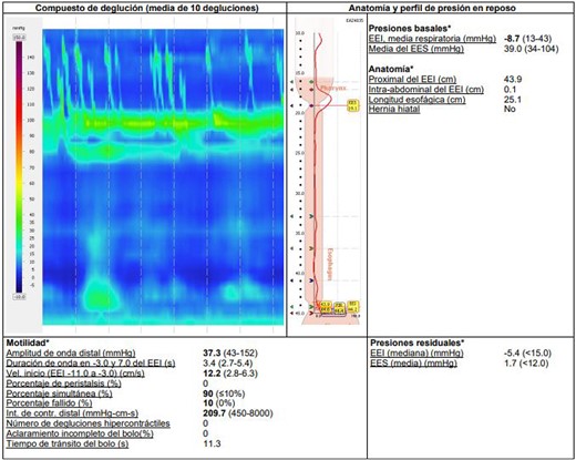 Esophageal manometry with evidence of panpressurization (achalasia type II).