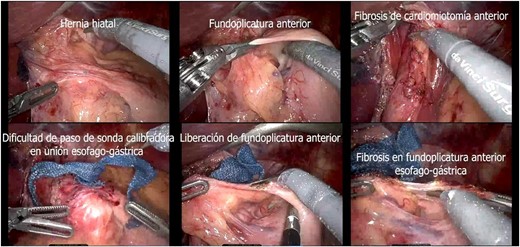 Transsurgical findings (hiatal hernia; anterior funfuplication; fibrosis of anterior cardiomyotomy; difficulty in passing the calibrating probe in the gastroesophageal junction; release of anterior fundoplication; fibrosis in anterior esophagogastric fundoplication).