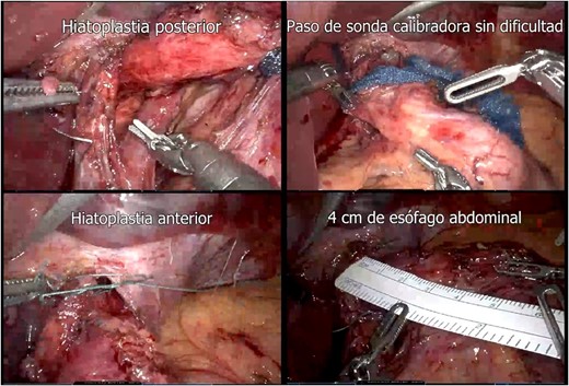 Hiatoplasty (posterior hiatoplasty; passage of gauge probe without difficulty; anterior hiatoplasty; 4 cm of abdominal esophagus).