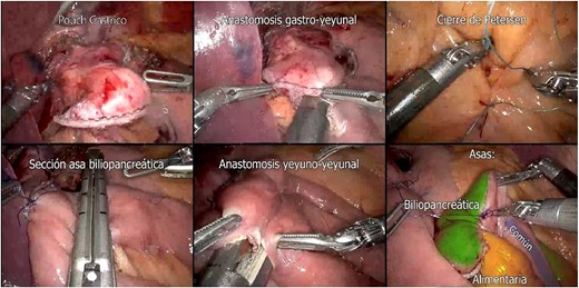 Preparation of Roux-en-Y Gastric Bypass (gastric pouch; gastrojejunal anastomosis; Petersen closure; biliopancreatic loop section; jejunojejunal anastomosis; biliopancreatic, common and alimentary loops).