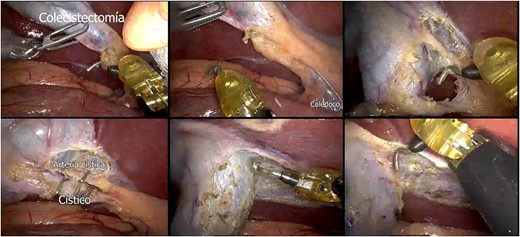 Robot-assisted laparoscopic cholecystectomy.