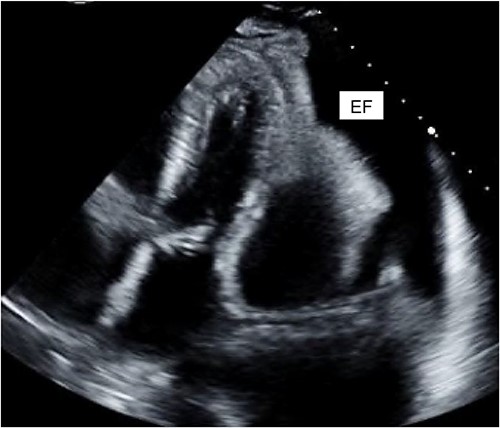 Cardiac ECHO images: ECHO images of the patient’s heart. EF represents effusion.