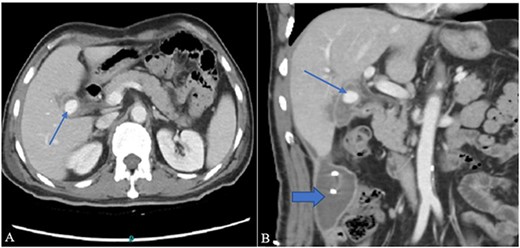 (A) Contrast-enhanced CT axial image through the abdomen shows a small walled-off collection in the GB fossa with a central contrast density representing pseudoaneurysm (arrow). The collection appears to be in communication with the second part of the duodenum. (B) A coronal image from the same CT shows a right para colic gutter collection with an in situ pigtail (broad arrow).