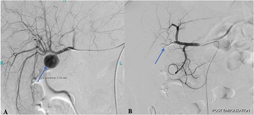 (A) Pre-embolization angiogram of the hepatic artery demonstrates pseudoaneurysm of the cystic artery stump (arrow). (B) Post-coil embolization angiogram of the hepatic artery shows no further filling of the pseudoaneurysm (arrow).