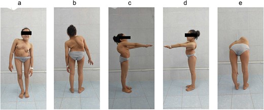Preoperative patient’s appearance: (a) front, (b) back, (c) right side, (d) left side, and (e) the Adams test is positive.