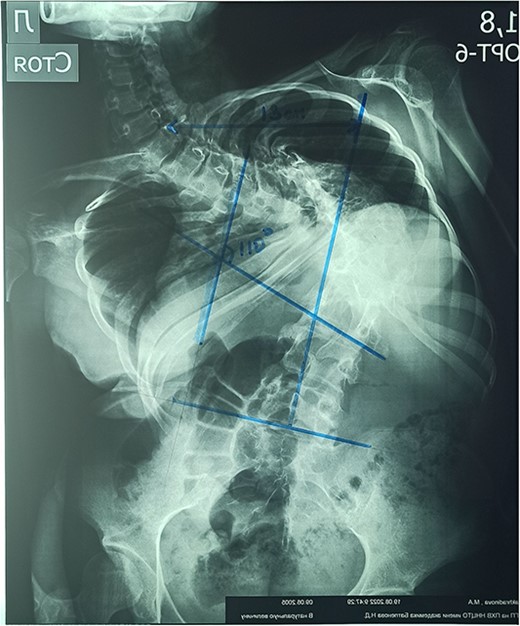 Preoperative anterior–posterior X-ray.
