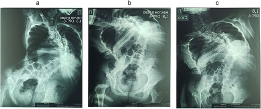 Preoperative functional X-ray: (a) inclination to the right, (b) inclination to the left, and (c) on stretching.