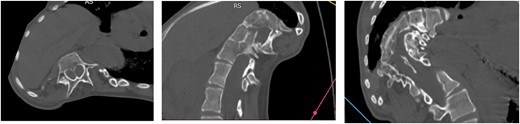 Preoperative CT: (a) axial, (b) sagittal, and (c) coronal.