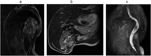 Preoperative MRI: (a) axial, (b) sagittal, and (c) coronal.
