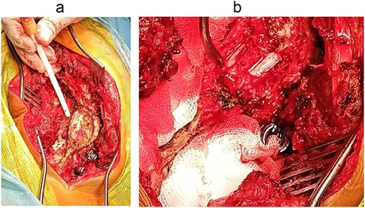Intraoperative images: (a) splitting of spinous processes of Th11, Th12, L1 vertebrae; (b) separation of the spinal cord into two arms (indicated by arrows).