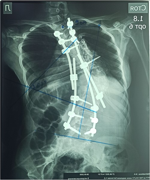 Postoperative anterior–posterior X-ray.