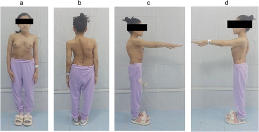 Postoperative patient’s appearance: (a) front, (b) back, (c) right side, and (d) left side.