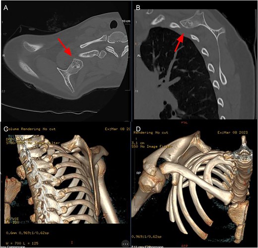 Axial (A) and sagittal (B) CT slices demonstrating lesion location, 3D reconstructions (C + D) further demonstrating morphology of lesion.