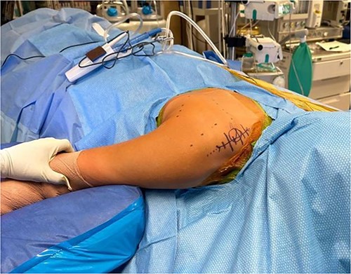 Demonstration of position and marking of the patient.