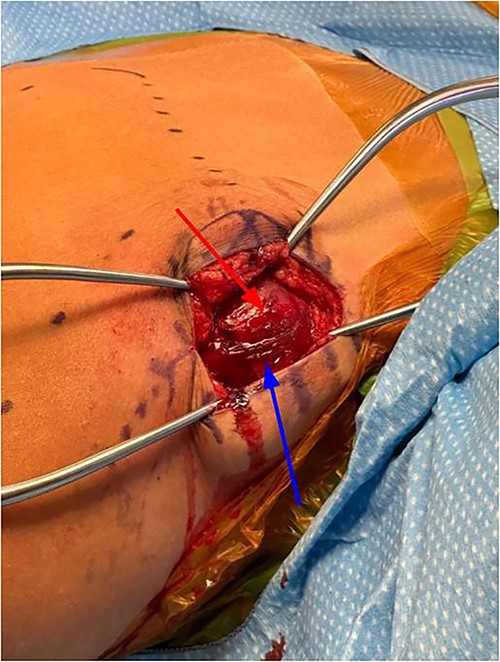 Exposure after superficial dissection, middle trapezius fibers (top arrow) and superior trapezius fibers (bottom arrow).