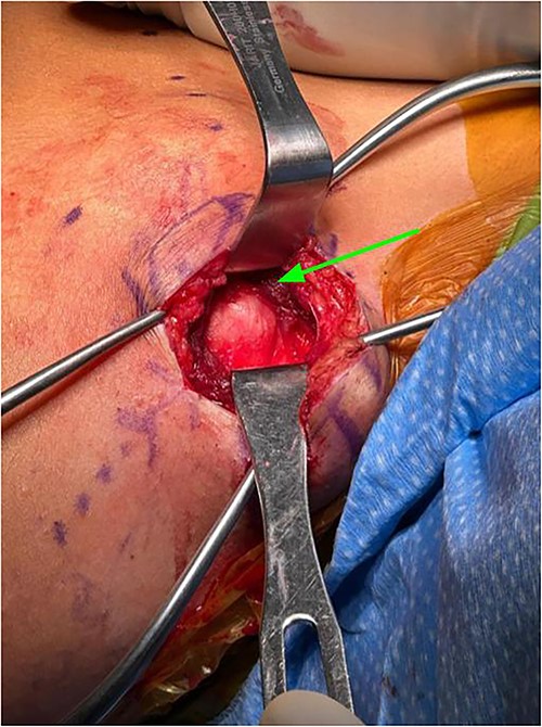 Exposure after trapezius had been split between middle and superior fibers, levator scapula fibers can be seen medial to lesion (identified by arrow).