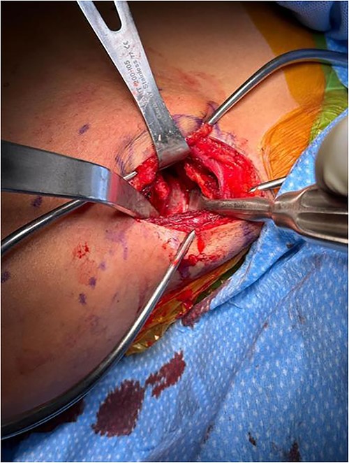 Exposure after scapula has been retracted and lesion was exposed, lesion can be directly visualized.