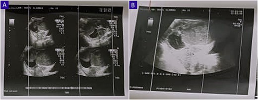 (A and B) Ultrasound of the abdomen and TVUS reveals a 9 cm x 6 cm thick-walled cystic mass in the left pelvic region; the mass exhibits irregular borders, a heterogeneous echotexture, and is multilocular with numerous septations.
