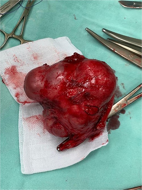 A surgical image shows a large cystic mass with a nodular appearance arising from the left ovary.