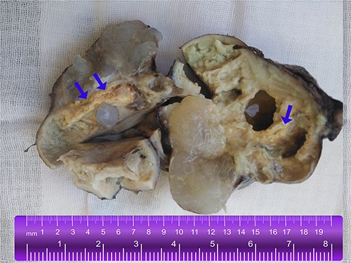 A gross image of the specimen shows a cystic mass measuring 9 cm x 7 cm x 5 cm; upon sectioning, the cyst is multilocular with variably sized septa, containing thick gelatinous mucoid material characteristic of a mucinous tumor; no solid areas or papillary excrescences; the adjacent tissue displayed yellowish areas (arrows).