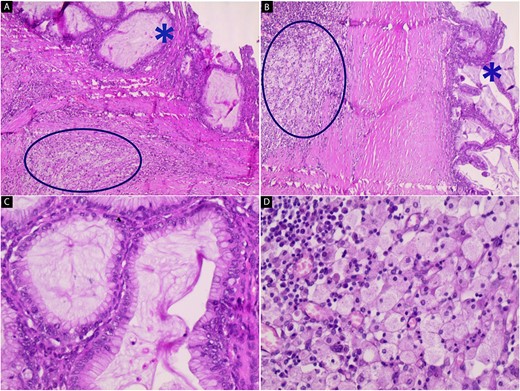 Hematoxylin and eosin stain (A–D); microscopic images of mass; (A and B) the low-power magnification reveals cystic glands lined by a single layer of non-ciliated, mucin-secreting, columnar epithelium without stromal invasion (star) with subepithelial fibrosis, foamy macrophages, and chronic inflammatory infiltrates (circle) (40x and 100x); (C and D) the high-power magnification shows mucin-secreting columnar epithelium and foamy macrophages with chronic inflammatory infiltrates respectively (200x and 200x).