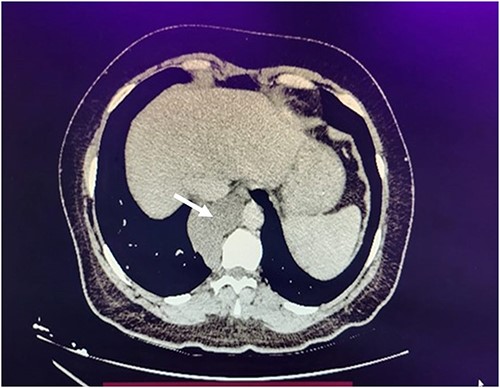 Axial chest computed tomography reveals an 8.2-cm nodule in the posterior mediastinum (white arrow).