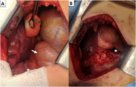 Right posterior thoracotomy before extracting the neuroganglioma (arrow) (A) and after extracting the neuroganglioma (B).