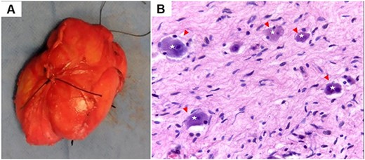 6.1 × 3.8 × 9.0-cm neuroganglioma extracted from the patient; (A) hematoxylin and eosin-stained slide at 4× and 40× magnification of the neuroganglioma; large ovoid cells with basophilic cytoplasm (star), surrounded by Schwannian stroma; (arrowhead) (B).