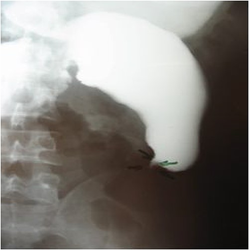 Esogastroduodenal transit showing gastroduodenal dilatation upstream of a tight jejunum stenosis.