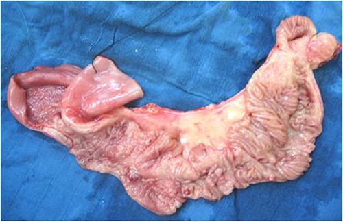 Gross appearance of jejunal loop stenosis.