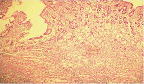 Diffuse infiltration of eosinophilic polymorphonuclear leukocytes affecting all layers of the jejunal wall (hematoxylin–eosin staining, magnification × 100).