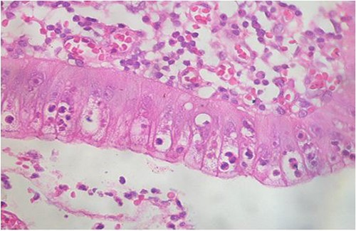 Intraepithelial exocytosis of eosinophilic polymorphonuclear leukocytes (hematoxylin–eosin staining, magnification × 200).