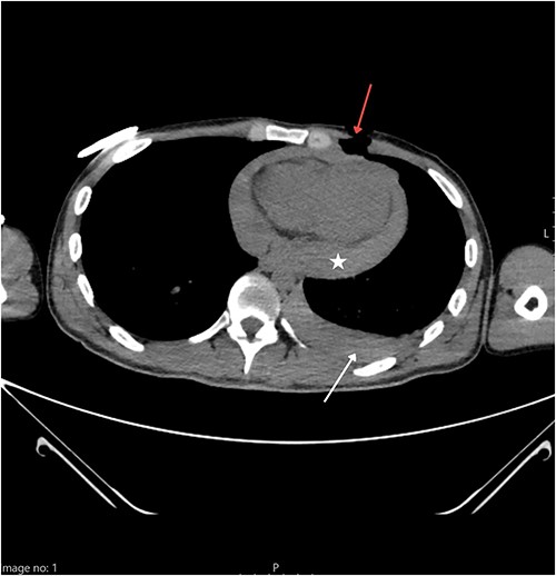Thoracic CT showing a penetrating wound to the left pectoral area (red arrow) along with hemorrhagic pleural effusion (white arrow) and hemopericardium (star).