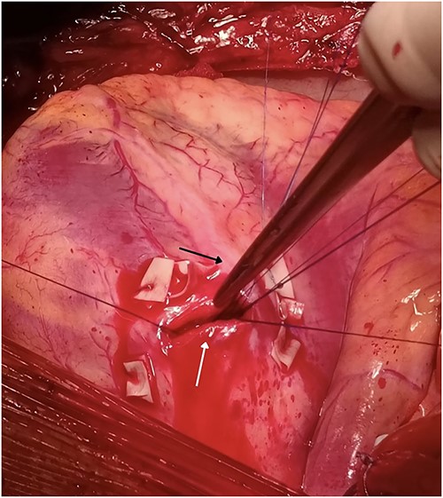 Penetrating wound to the LV measuring 2 cm (white arrow) missing the LAD (black arrow) by 2 mm but transecting the second diagonal branch of the LAD.