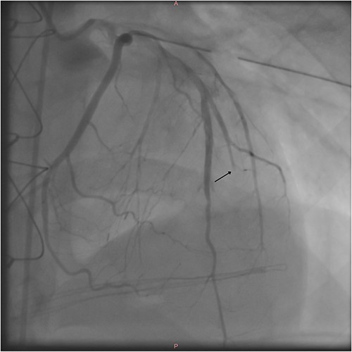 Postoperative coronary angiography shows a transected second diagonal branch of the LAD (arrow).