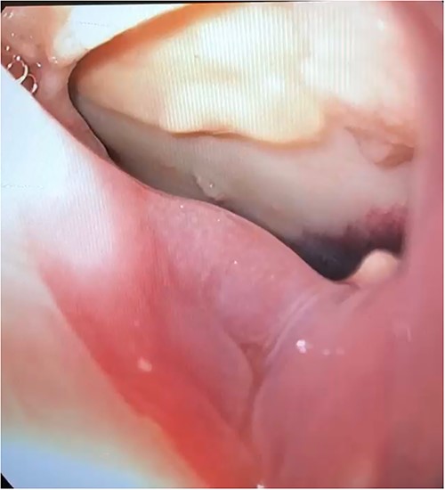 Endoscopic view of pericardioesophageal fistula of Case 1.