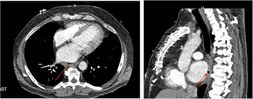 (a) Axial CT image of pericardioesophageal fistula of Case 4 (arrow indicates area of fistulization); (b) sagittal CT image of pericardioesophageal fistula of Case 4 (arrow indicates area of fistulization).