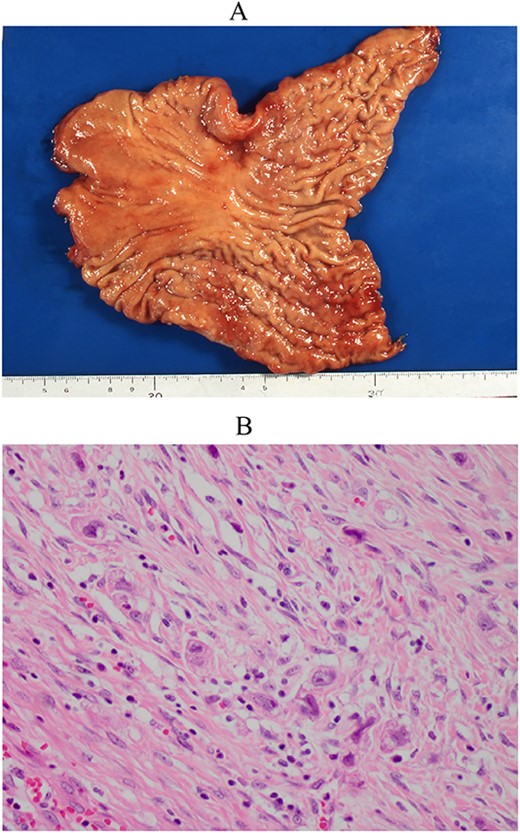 Resected specimen of the first gastrectomy. (A) A type 4 tumour was detected at the anterior of the angular lesion. (B) Poorly differentiated adenocarcinoma was detected (HE, ×400).