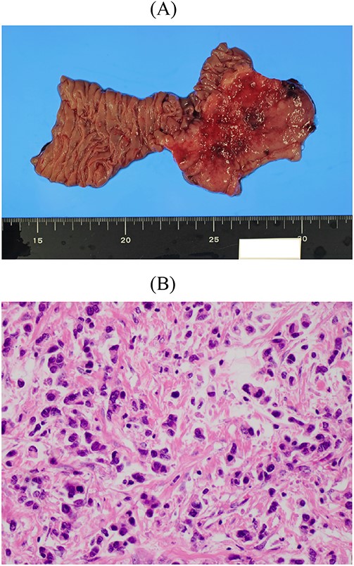 Resected specimen of the second gastrectomy. (A) A type 4 tumour was detected at the entire remnant stomach. The surgical margins were negative. (B) Poorly differentiated adenocarcinoma (non-solid type) was detected (HE, ×400).