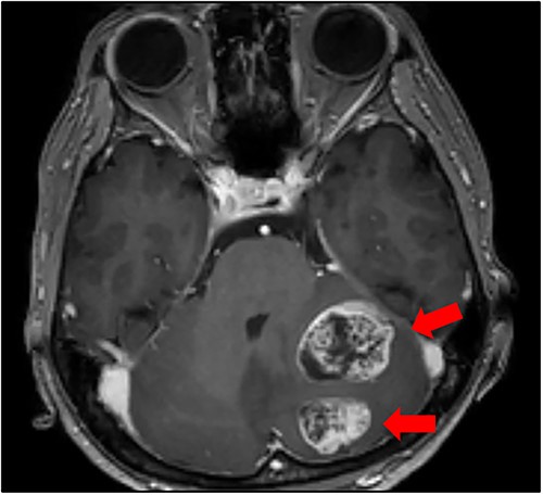 Cranial MRI findings (T1-weighted image). Two ring-enhanced masses with maximum diameters of 3.3 and 2.4 cm were observed in the left cerebellum.