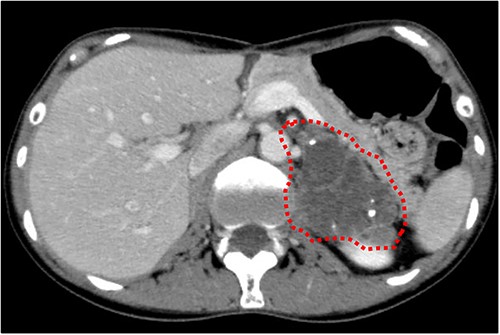 Abdominal CT findings. A calcified tumour with a maximum diameter of 6.0 cm was observed in the left adrenal gland.