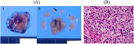 Resected specimen of the cerebellar tumours. (A) Two resected specimens of the cerebellum. (B) Signet-ring cell carcinoma was detected (HE, ×400).