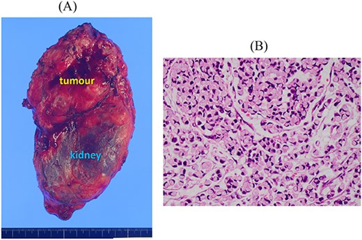 Resected specimen of the left adrenal gland tumour. (A) The tumour resected with the left kidney. (B) Signet-ring cell carcinoma was detected (HE, ×400).