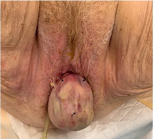 Small bowel prolapsing through vaginal vault associated with mottling of mucosa (indicated by the arrow).