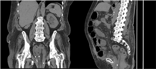 CT coronal (left) and sagittal (right) of abdomen and pelvis, demonstrating extension of small bowel into the pelvis (marked with star) consistent with perineal hernia.